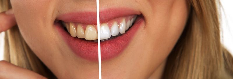 clean stains from teeth